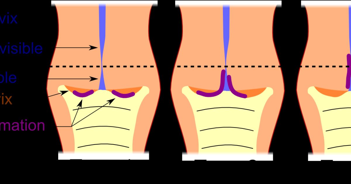 Cervical Lesions: Screening, Colposcopy and Treatment Explained