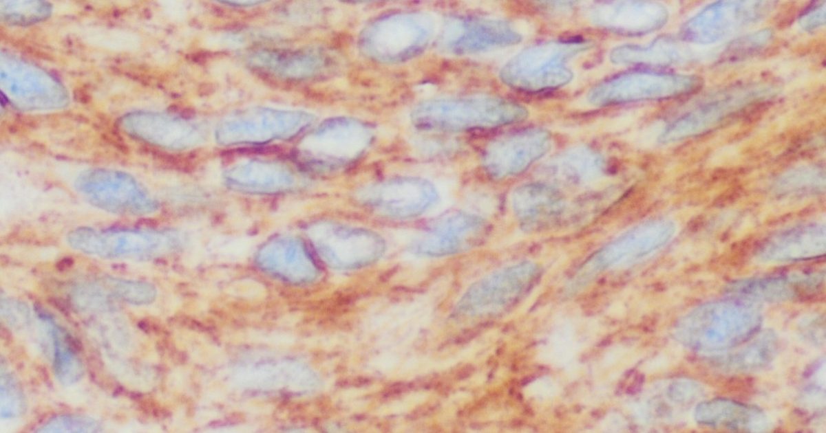 Gastrointestinal Stromal Tumour (GIST): 2025 Diagnosis and Treatment Guide