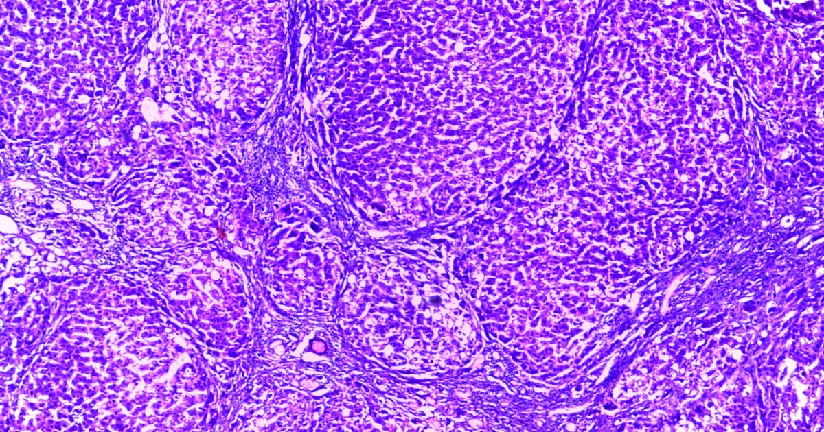 Hepatic Encephalopathy in Cirrhosis: The 2024 Chinese Guideline