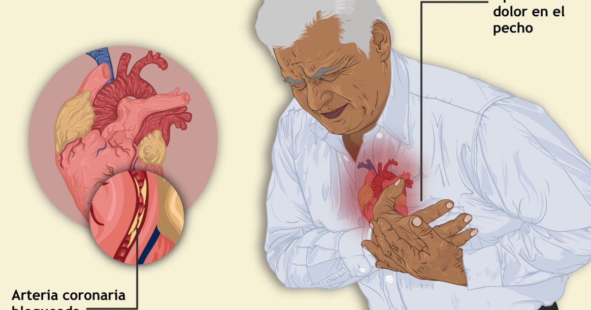 STEMI 2025: How a Heart Attack Is Diagnosed and Treated in China